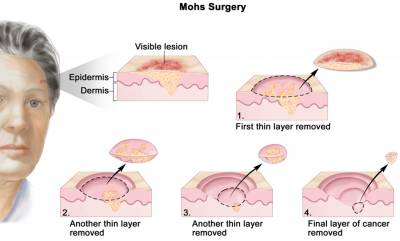 MOHS surgery